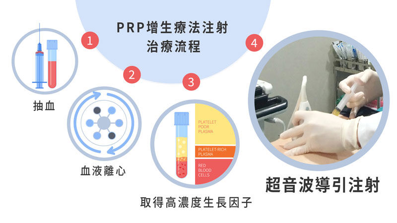 膝关节退行性关节炎