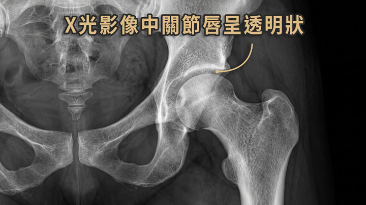 髖關節X光